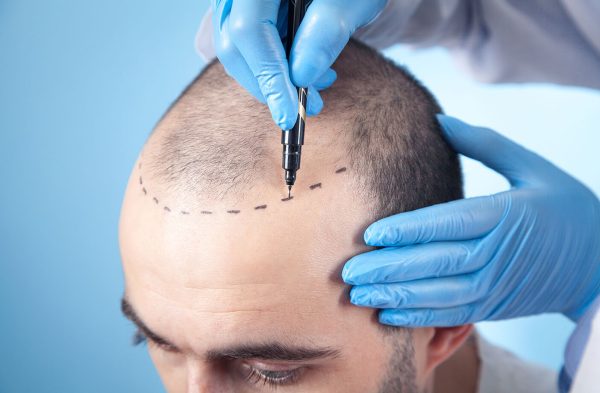 زراعه الشعر